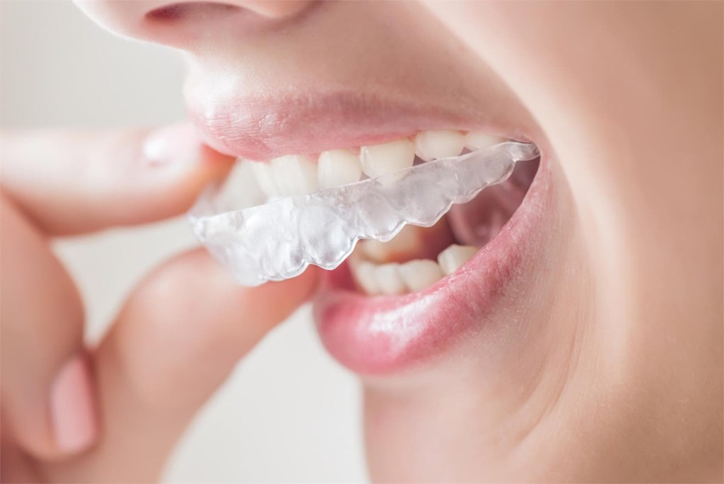 5 motivos por los que la ortodoncia invisible es la opción perfecta para ti