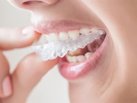 5 motivos por los que la ortodoncia invisible es la opción perfecta para ti