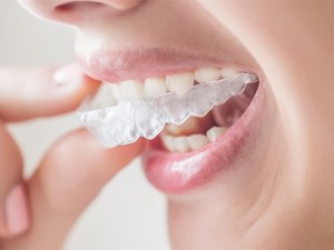 5 motivos por los que la ortodoncia invisible es la opción perfecta para ti