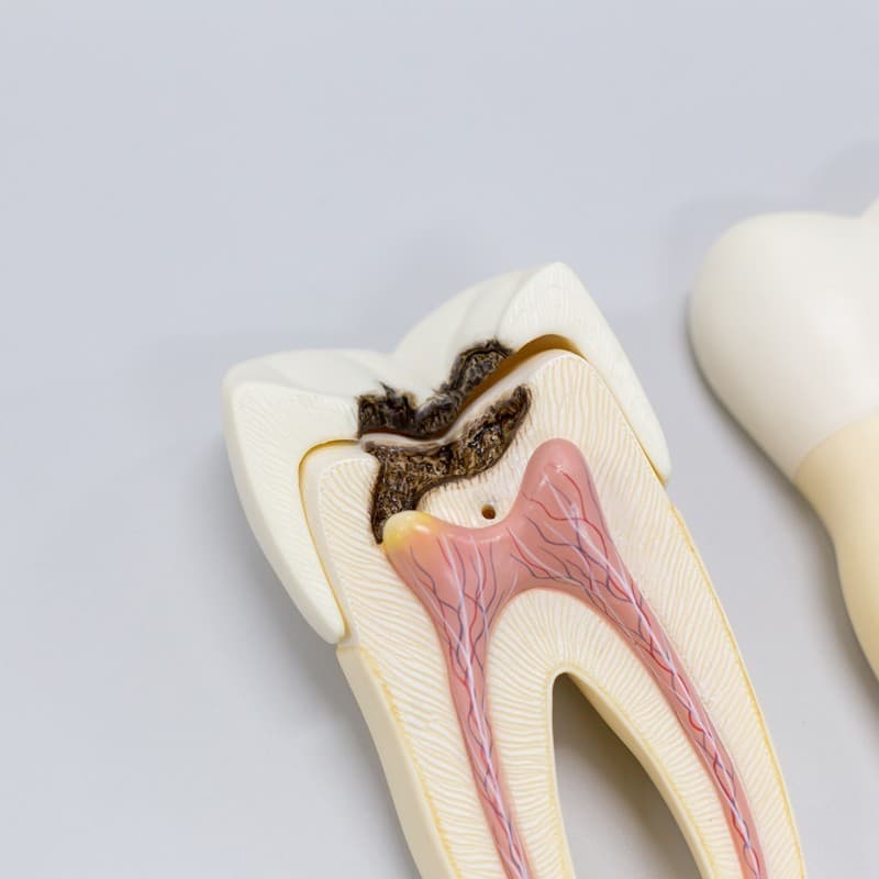 Endodoncia en Baiona