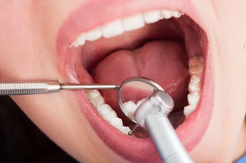 Endodoncia en Baiona