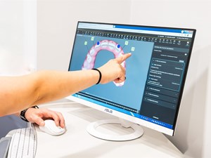 ¿Qué esperar el primer día con tus alineadores Invisalign?