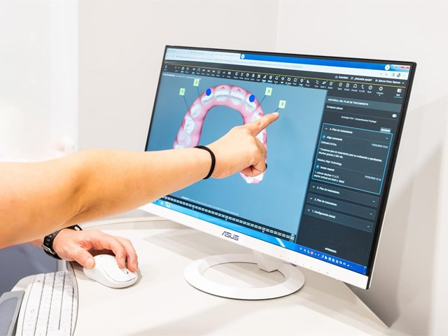 ¿Qué esperar el primer día con tus alineadores Invisalign?